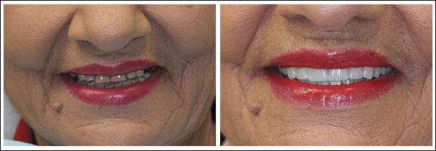 Before and after images of dental work at Brandon Dental Care in Tupelo, MS.