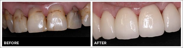 Before and after images of dental work at Brandon Dental Care in Tupelo, MS.