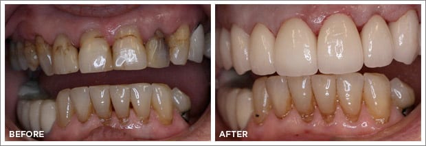 Before and after images of dental work at Brandon Dental Care in Tupelo, MS.