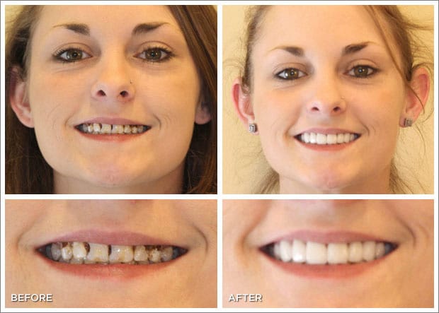 Before and after images of dental work at Brandon Dental Care in Tupelo, MS.
