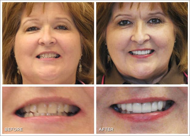Before and after images of dental work at Brandon Dental Care in Tupelo, MS.