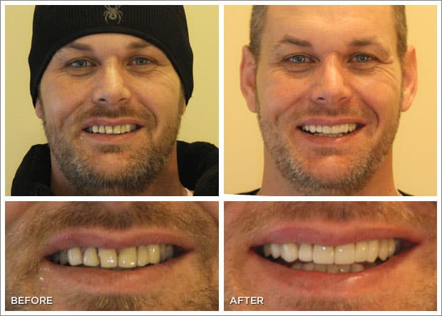 Before and after images of dental work at Brandon Dental Care in Tupelo, MS.