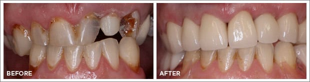 Before and after images of dental work at Brandon Dental Care in Tupelo, MS.