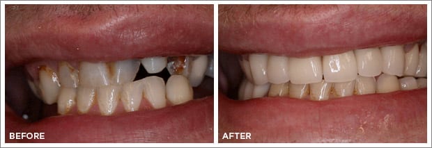 Before and after images of dental work at Brandon Dental Care in Tupelo, MS.