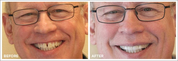 Before and after images of dental work at Brandon Dental Care in Tupelo, MS.