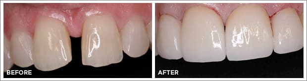 Before and after images of dental work at Brandon Dental Care in Tupelo, MS.