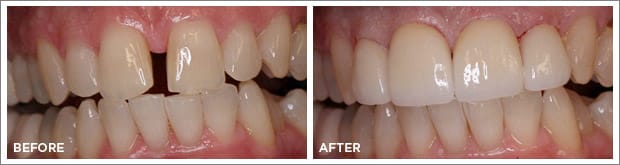Before and after images of dental work at Brandon Dental Care in Tupelo, MS.
