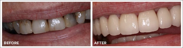 Before and after images of dental work at Brandon Dental Care in Tupelo, MS.