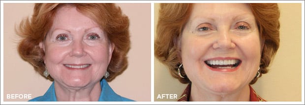 Before and after images of dental work at Brandon Dental Care in Tupelo, MS.