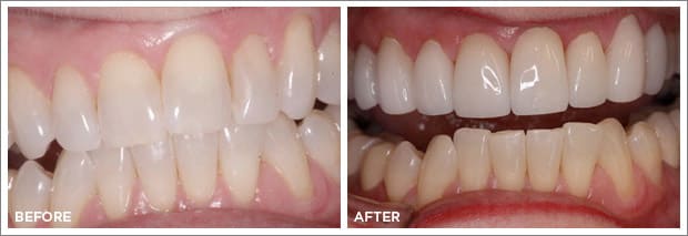 Before and after images of dental work at Brandon Dental Care in Tupelo, MS.