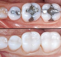 Traditional silver fillings replaced with tooth colored fillings.